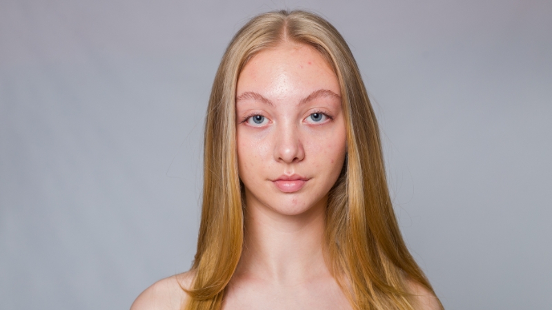 Tinejdžerka sa blagim aknama na licu stoji ispred svetle pozadine
