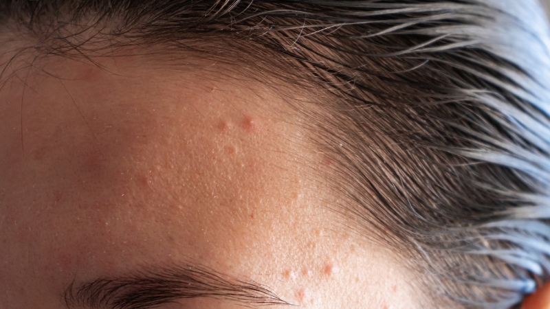 Pubertetske bubuljice na čelu izbliza